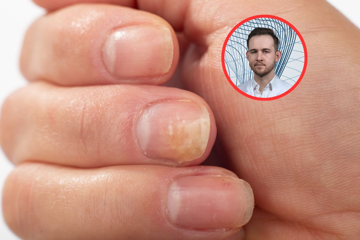 Przyczyny grzybicy. Dermatolog wymienia błędy, które jej sprzyjają