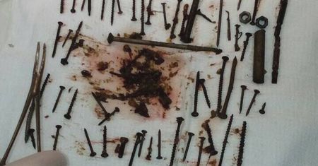 Przerażające odkrycie lekarzy. Wyjęli 150 metalowych elementów z brzucha więźniarki