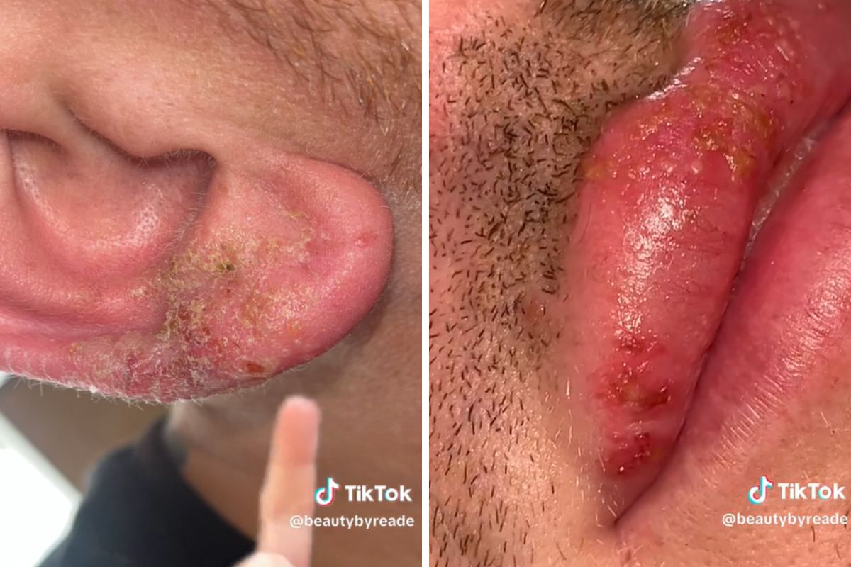 Pokazał pęcherze na skórze po oparzeniu słonecznym