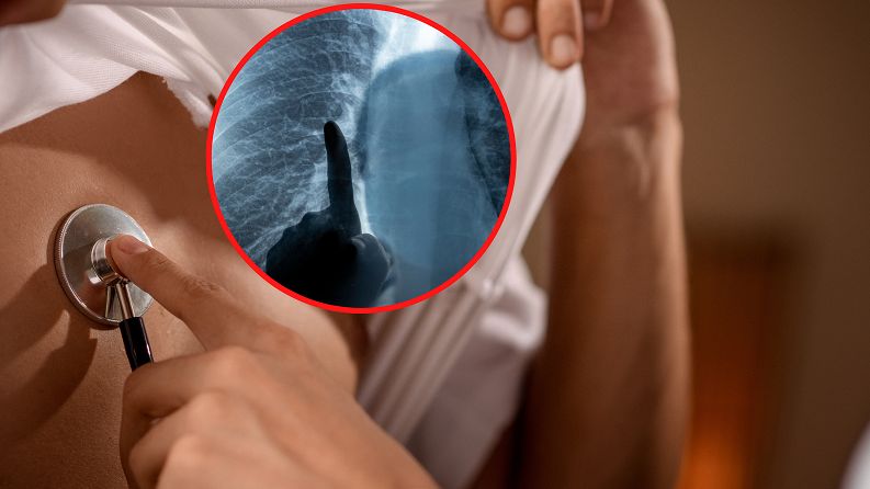 Wirus RSV jest bardzo groźny szczególnie dla małych dzieci