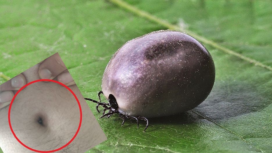 Kleszcz w pępku