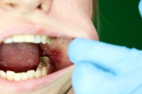 Nadżerka w jamie ustnej – przyczyny, objawy i leczenie