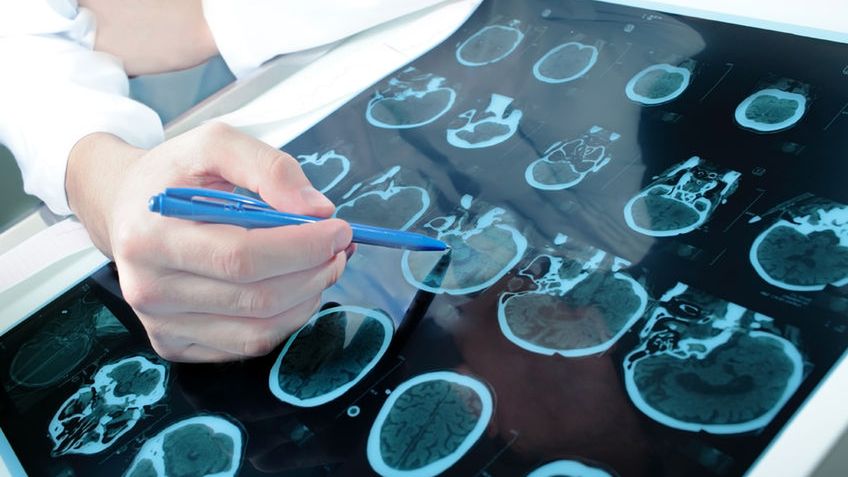 Guz mózgu u pacjenta z Kalifornii w niewyjaśniony sposób zniknął 