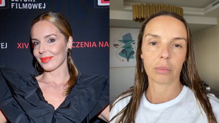 Agnieszka Włodarczyk szczerze o zabiegach kosmetycznych