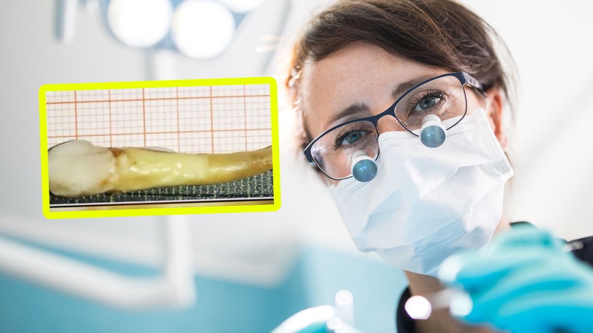 Dentyści usunęli pacjentowi rekordowej długości ząb