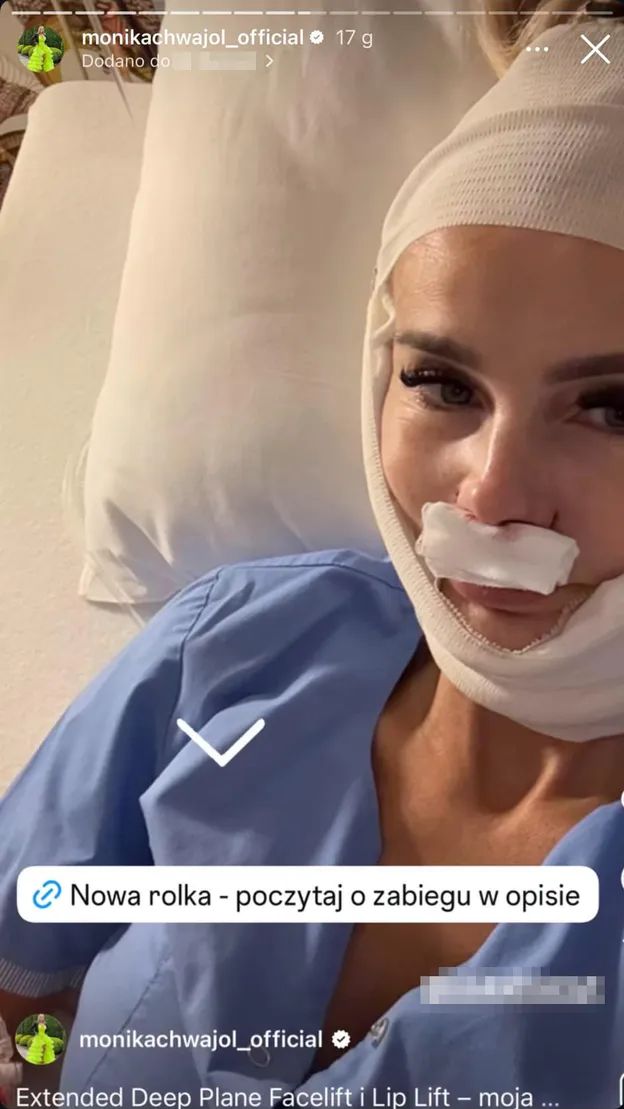 Monika Chwajoł po liftingu i lip lifcie