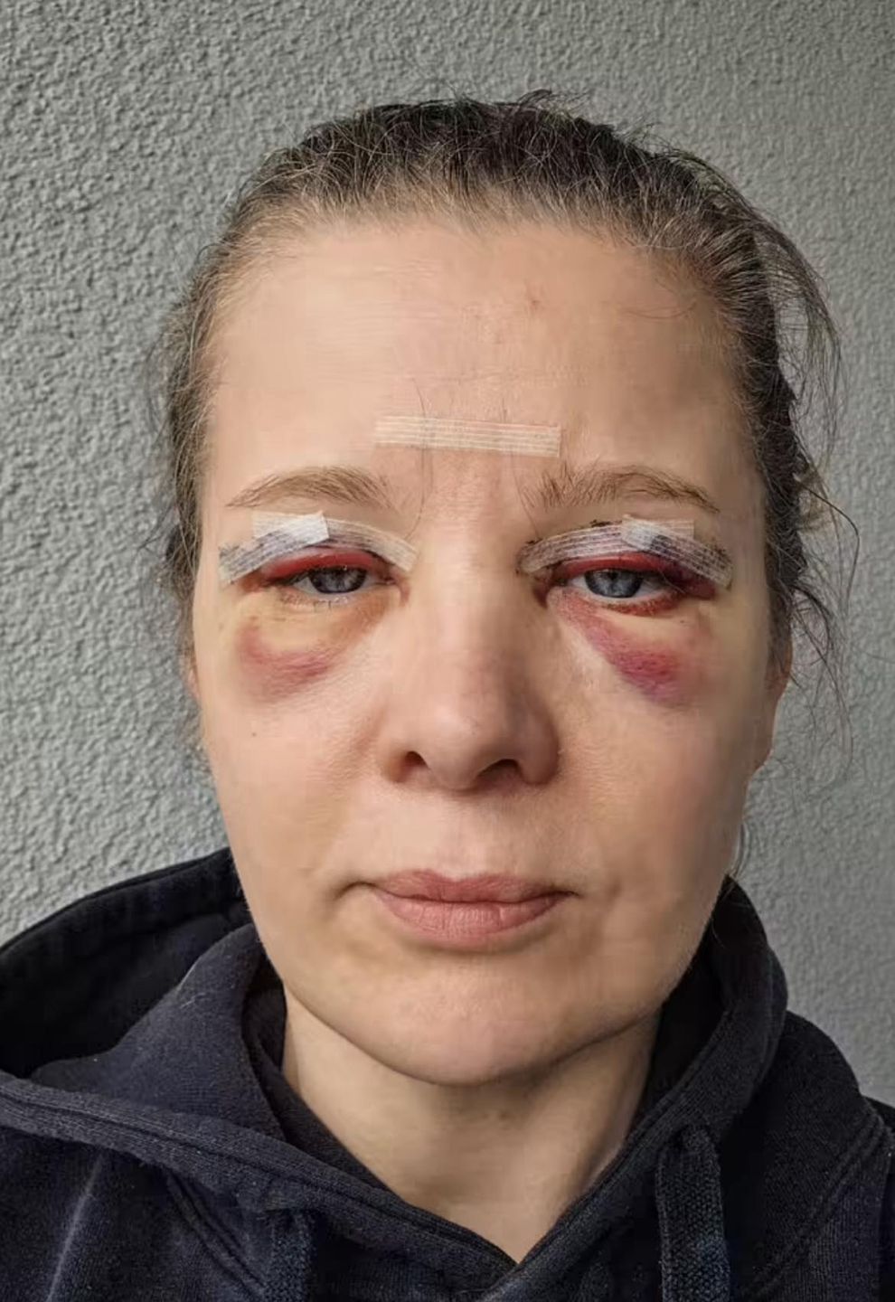 Anna Powierza wycięła nadmiar skóry na powiekach