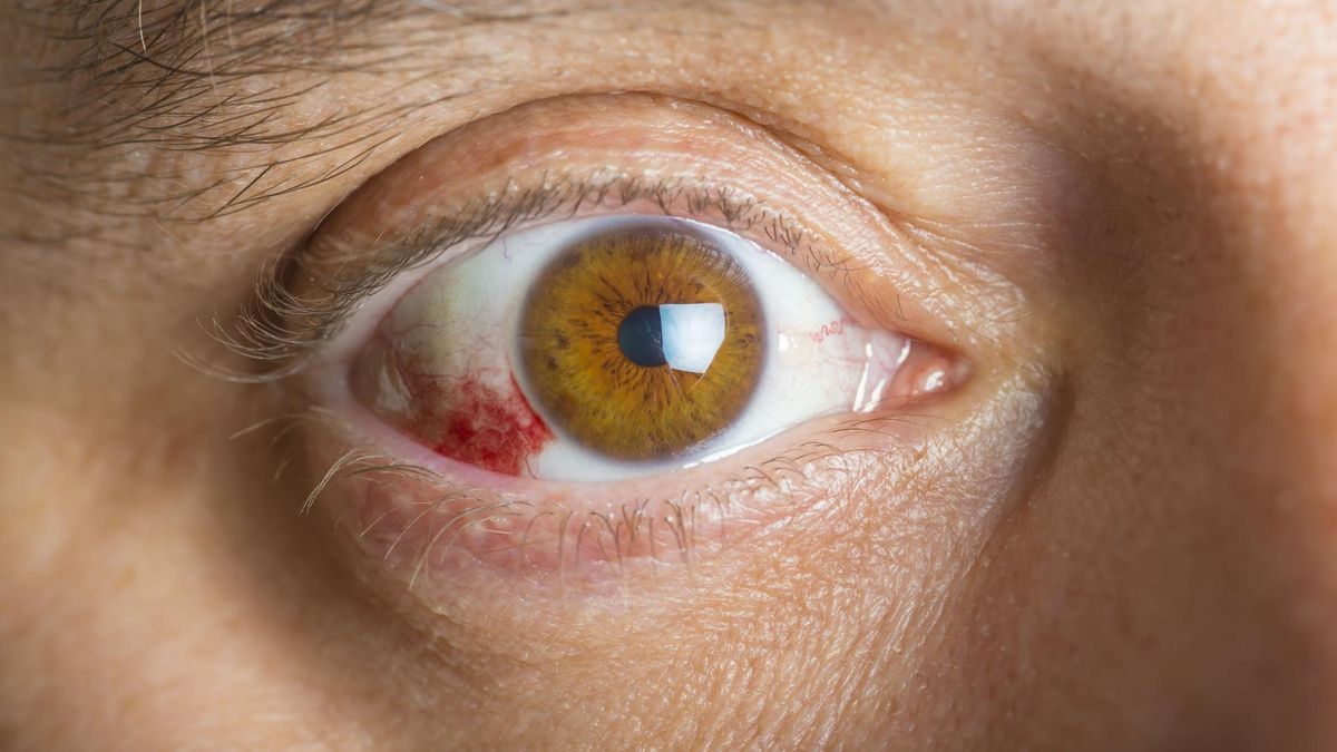 123rf.com Wylewy podspojówkowe mogą być objawem chorób