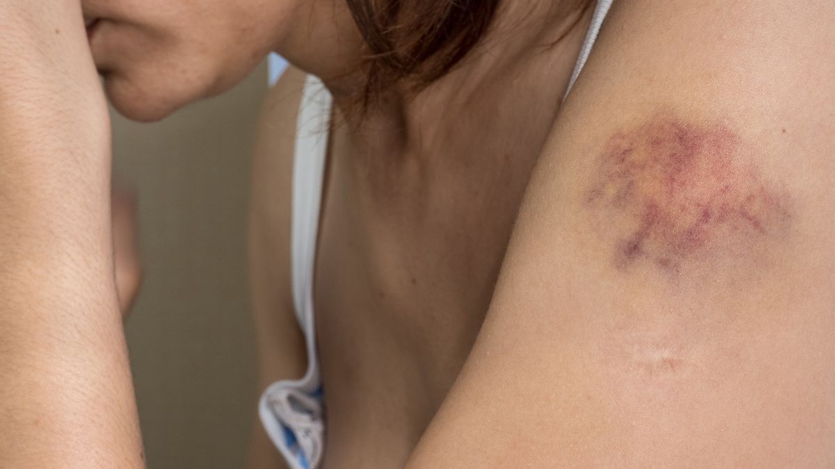 Uważaj na "malinki". Mogą być śmiertelnym zagrożeniem