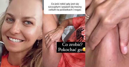 Anna Lewandowska pokazuje cellulit i radzi, jak sobie z nim poradzić: "POKOCHAĆ GO"!