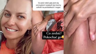 Anna Lewandowska pokazuje cellulit i radzi, jak sobie z nim poradzić: "POKOCHAĆ GO"!