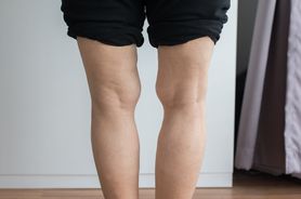Koślawość kolan u dzieci. Jakie są przyczyny tego schorzenia i jak przebiega leczenie?