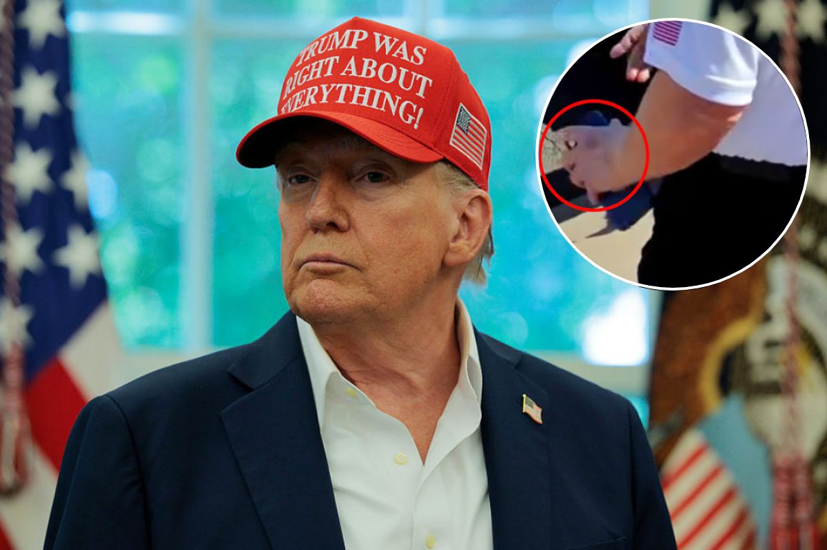 Nowy siniak na dłoni Donalda Trumpa. Rzeczniczka Białego Domu tłumaczy