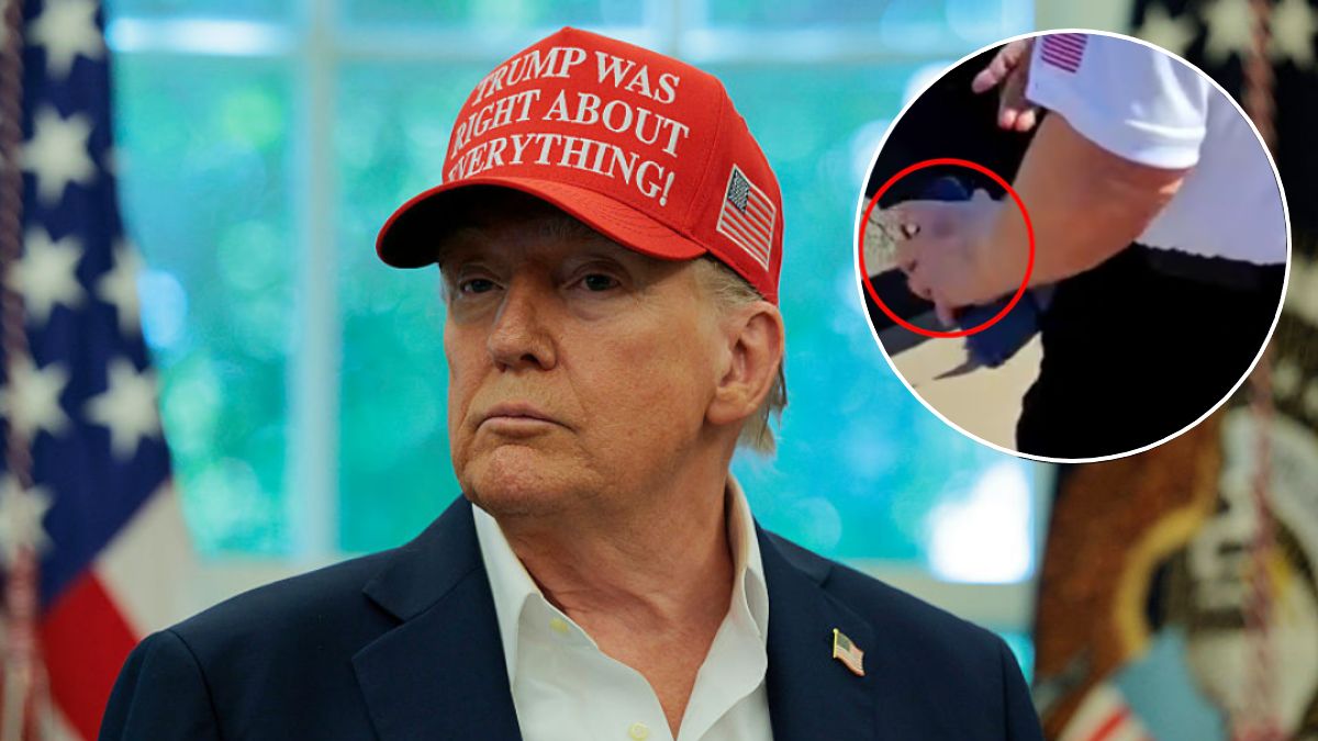 Nowy siniak, tym razem na lewej dłoni Trumpa