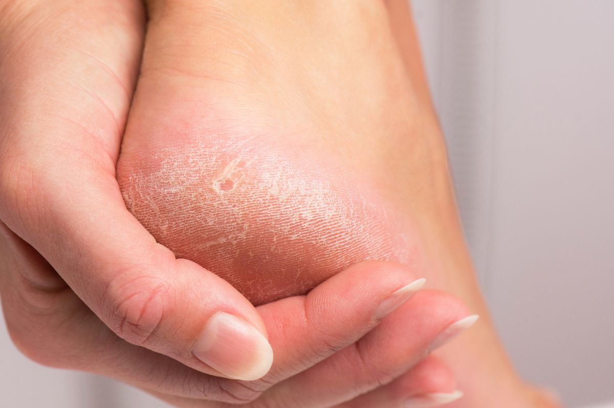 Restoring smoothness to cracked heels doesn't have to be expensive at all.