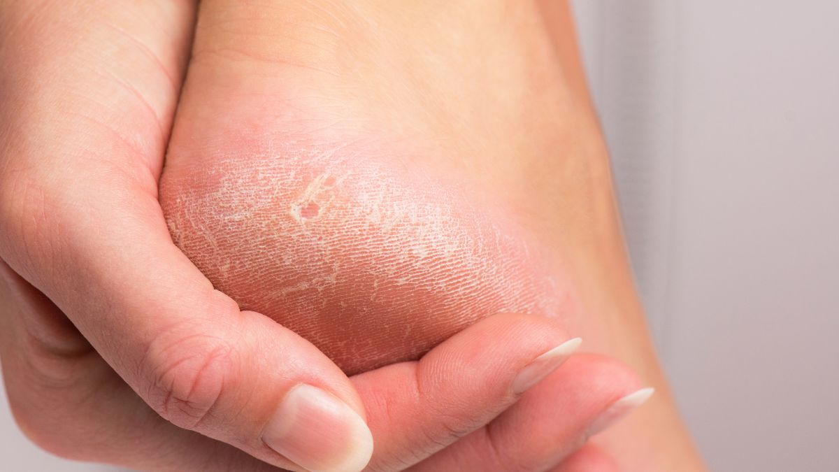 Jak przywrócić piętom gładkość?