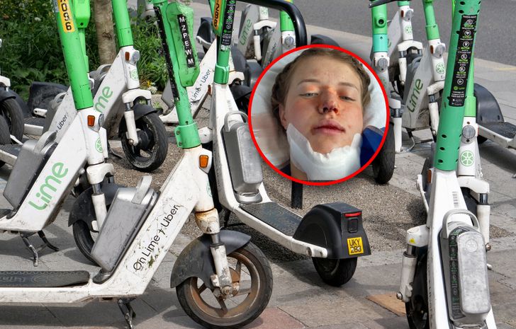 "To był koszmar". Tak wygląda jej życie po wypadku na hulajnodze