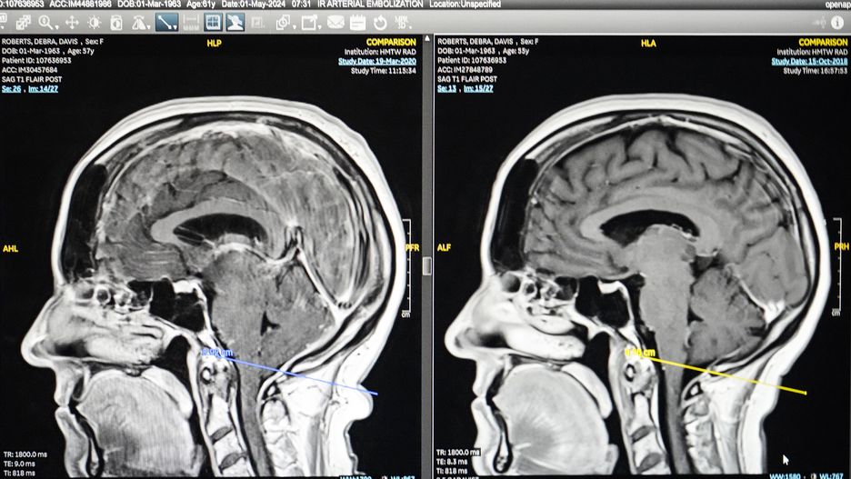 HOUSTON, TEXAS - JULY 14: Dr. Kurt Yaeger looks at scans of Debra Roberts' brain showing cerebrospinal fluid leak, left, that caused brain sag at Houston Methodist Hospital in Houston, Monday, July 14, 2025. Yeager and doctors at Methodist are pioneering a minimally-invasive surgery to fix spinal fluid leaks that have caused brain sag. (Brett Coomer/Houston Chronicle via Getty Images)