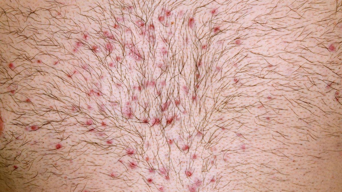 Zakażenie Omikronem widać na skórze. Nie lekceważ tego objawu COVID-19