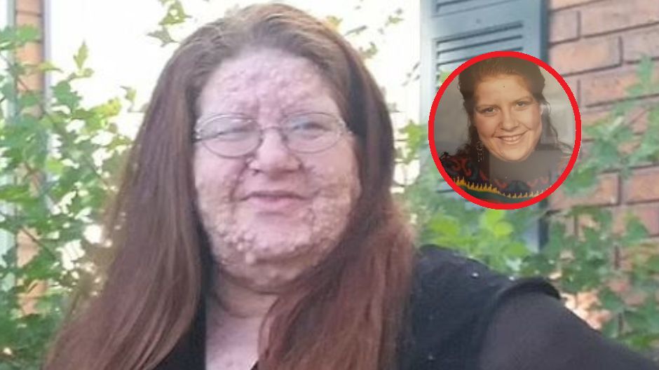 Twarz Mercedes Christensen pokryta jest setkami guzów