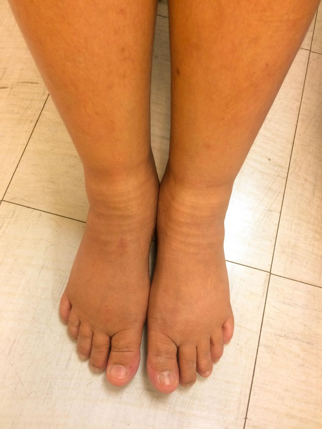 123rf.com Źle dobrane obuwie może skutkować puchnięciem kostek 