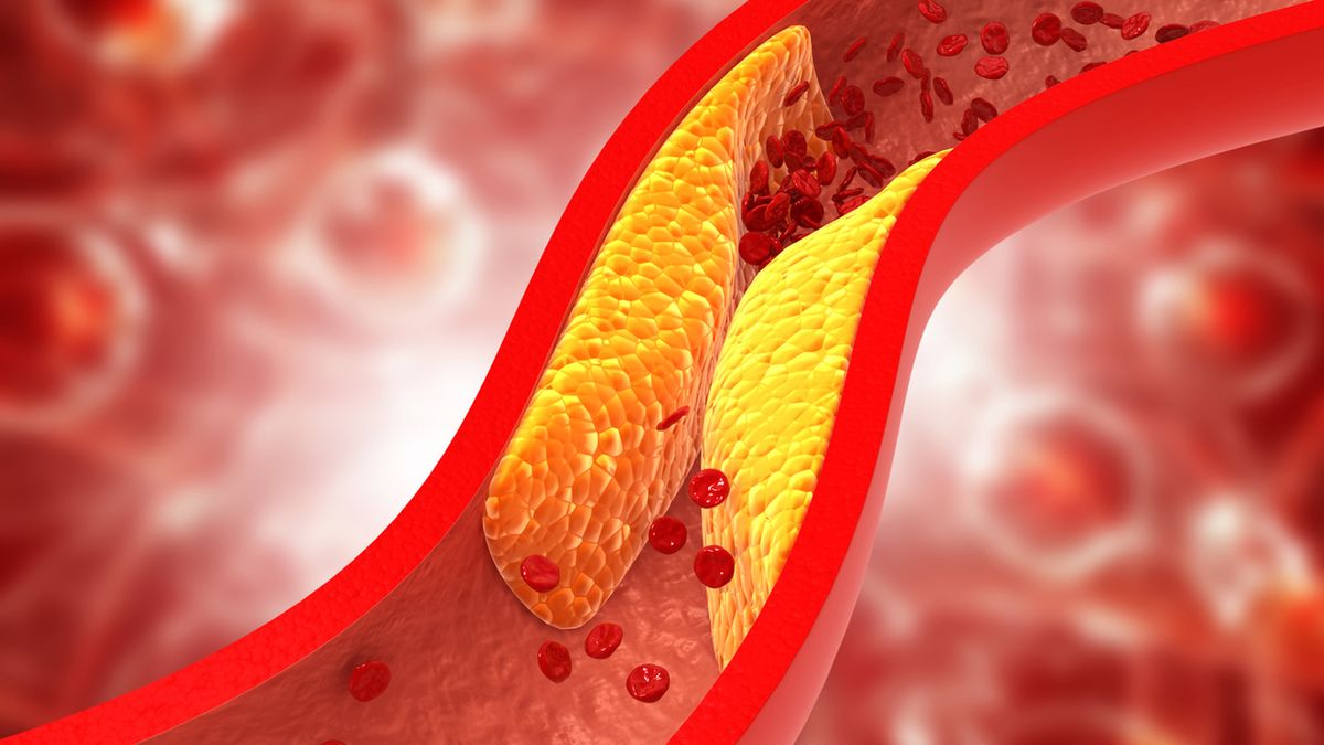 Hipercholesterolemia oznacza podwyższone stężenie cholesterolu LDL we krwi.