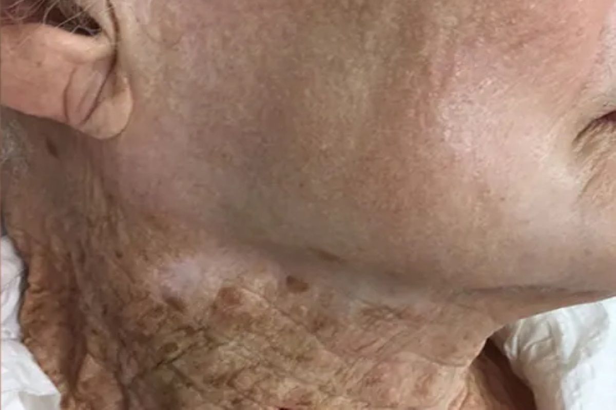 40 lat nakładała krem z filtrem tylko na twarz. Zdjęcie daje do myślenia