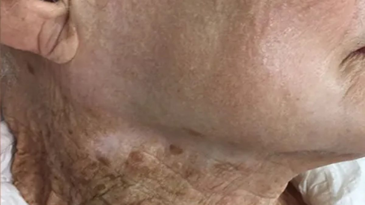 Tak będzie wyglądała twoja skóra, jeśli zapomnisz o nałożeniu kremu z filtrem