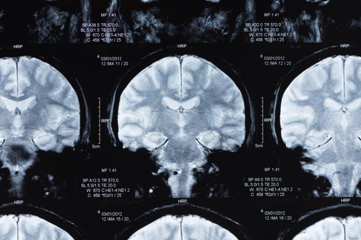 Tomografia komputerowa czaszki