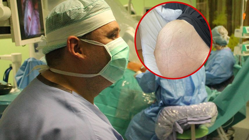 Coraz więcej pacjetek z gigantycznymi guzami jajnika