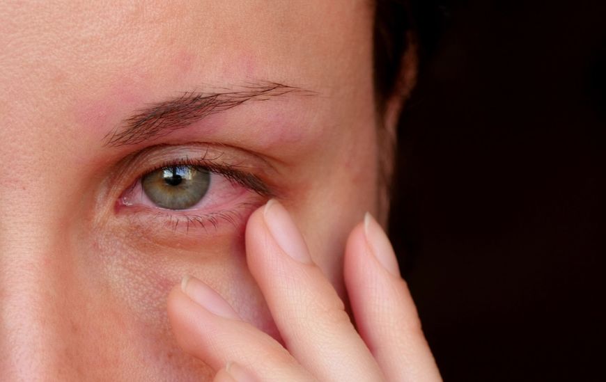 Zaczerwienione oczy mogą świadczyć o zespole suchego oka.
