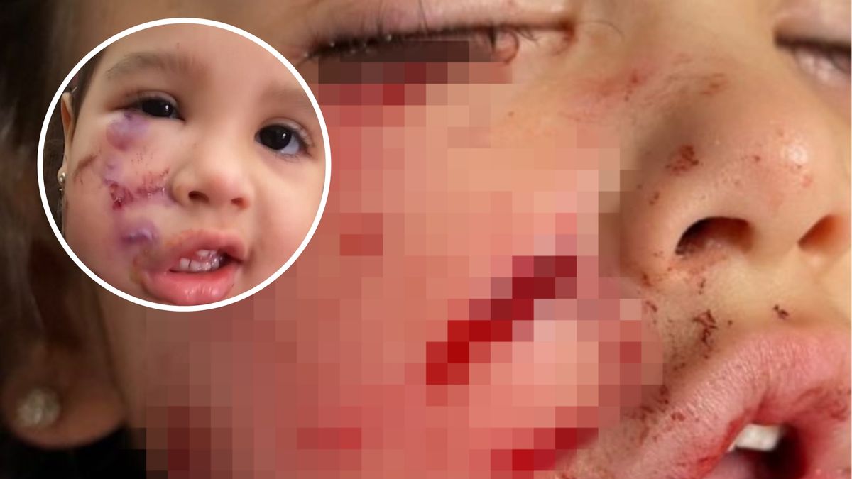 Dziewczynkę pogryzł pies