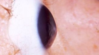 Sztuczna rogówka przywraca wzrok 1