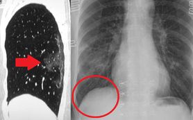 Zobacz, jak koronawirus niszczy płuca. Naukowcy z Akademii Medycznej w Czengdu udostępniają zdjęcia