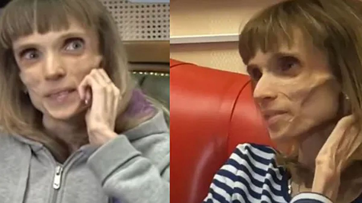 Kristina w najgorszym momencie ważyła zaledwie 17 kilogramów