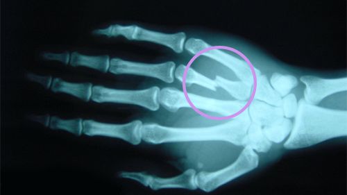 Pierwsza pomoc - złamania kończyn 1