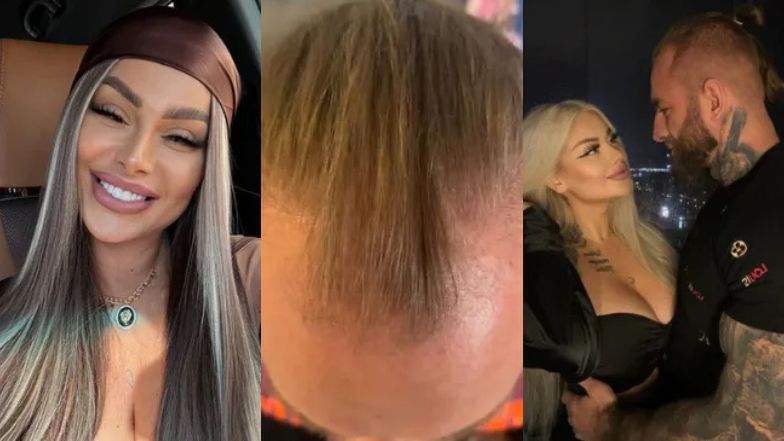 Ukochany Ewel0ny pokazał włosy po przeszczepie