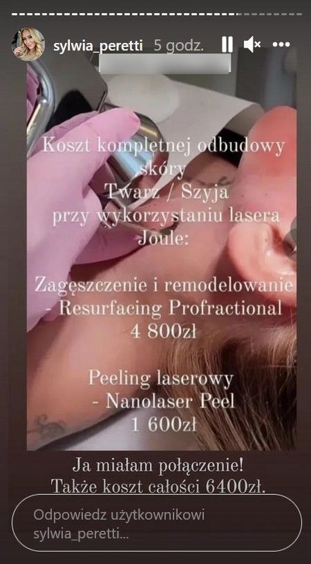 Sylwia Peretti po zabiegu laserowym
