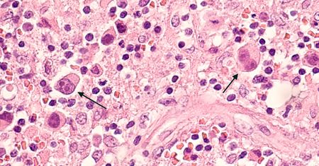 Biopsja węzłów chłonnych - cel biopsji, przebieg, wynik