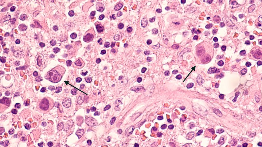 Obraz mikroskopowy węzła chłonnego u pacjenta z chorobą Hodgkina (chłoniaka), przedstawiający dwie komórki Reeda Sternberga w tym samym polu.