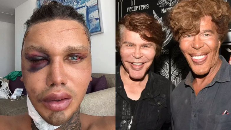 Ten 25-latek ma za sobą 15 operacji plastycznych. Teraz komentuje zabiegi innych