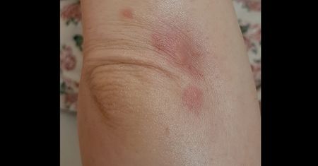 COVID-19 może aktywować choroby autoimmunologiczne. "Od miesięcy nie mogę wrócić do zdrowia"