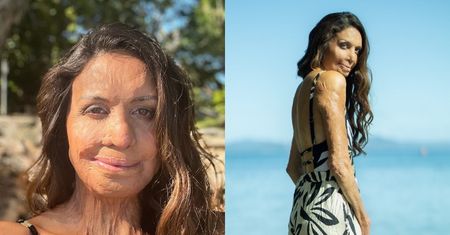 Turia Pitt cudem uszła z życiem, wydostając się z pożaru. Tak dziś wygląda uczestniczka tragicznego ultramaratonu (ZDJĘCIA)