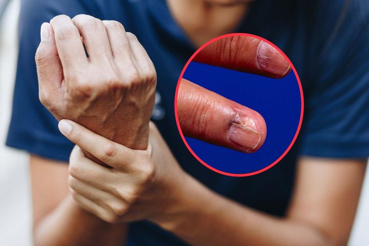 Czerniak paznokcia nie zawsze daje typowe objawy, dlatego łatwo go pomylić np. z infekcją grzybiczą