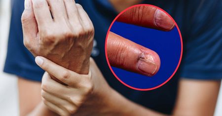 Ten nowotwór łatwo pomylić ze zwykłym krwiakiem. Leczenie może skończyć się amputacją
