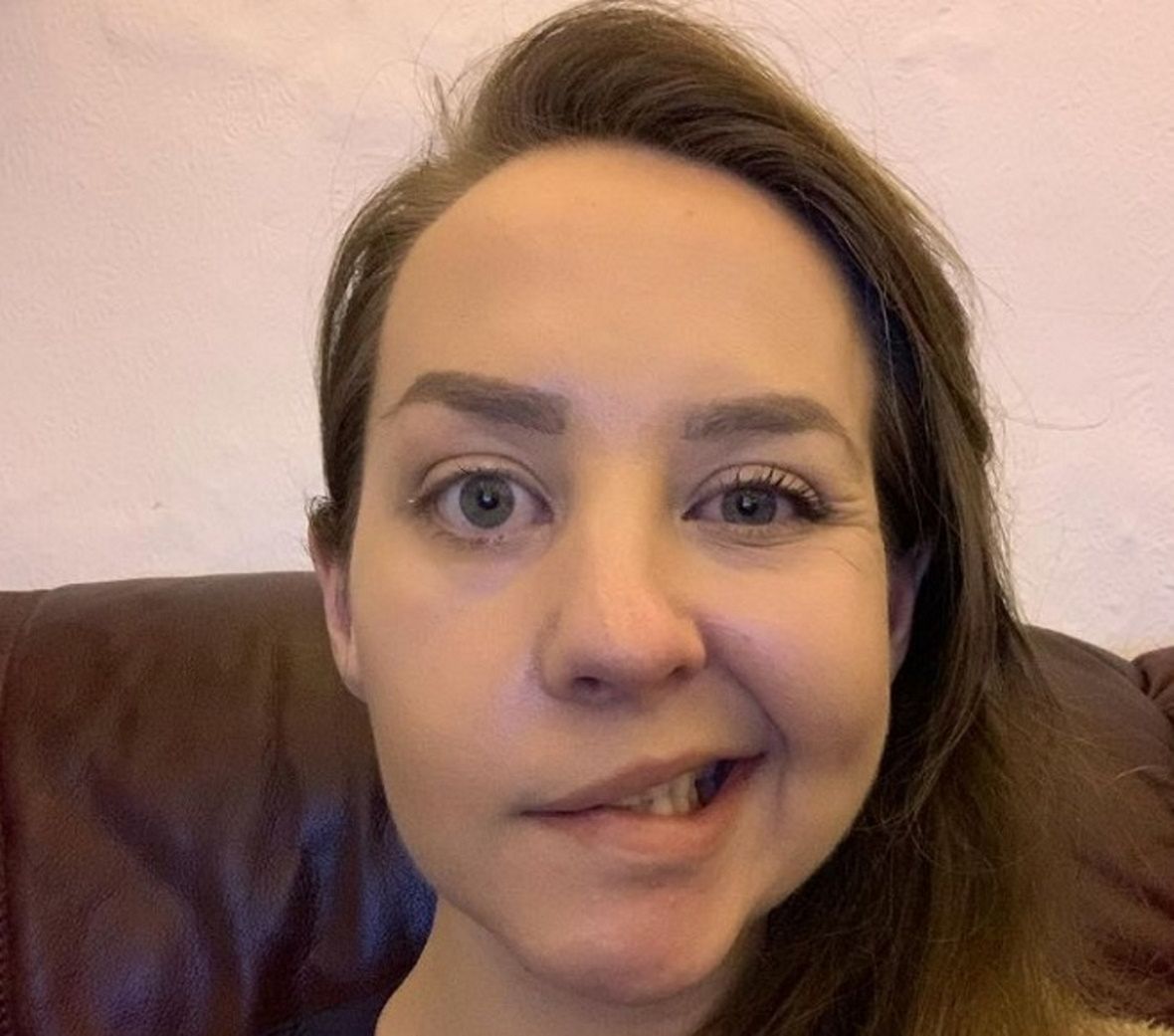 Cierpi na zespół Ramsaya Hunta