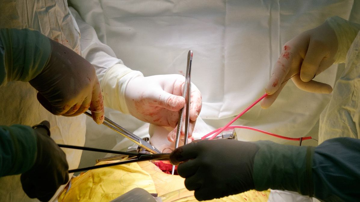 Wszczepienie bajpasów polega na przywróceniu przepływu krwi z aorty do zaatakowanych przez blaszki miażdżycowe tętnic wieńcowych.