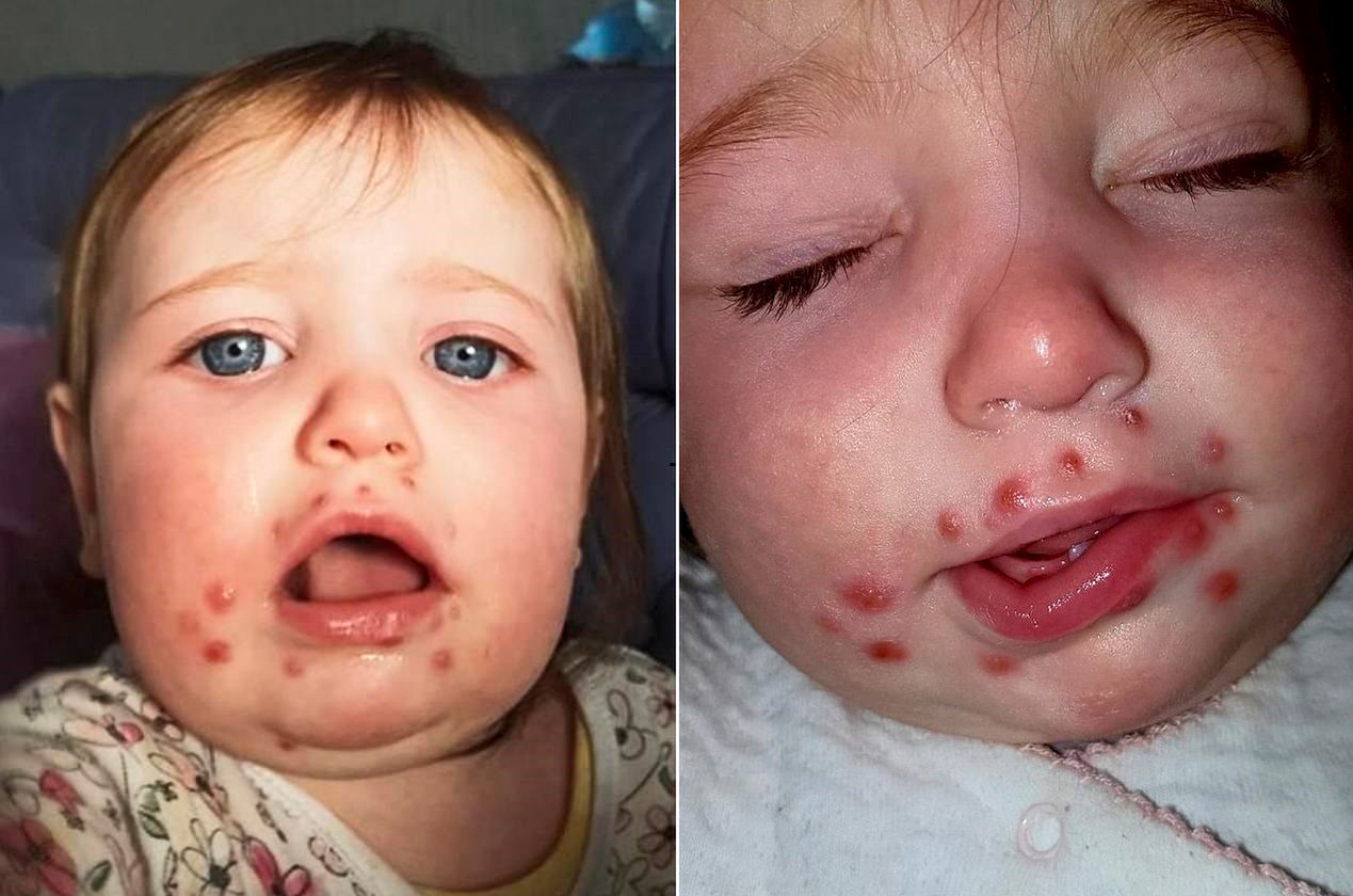 Dziecko nie mogło jeść ani pić. Wszystko przez wirus opryszczki