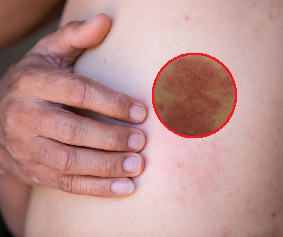 Tak dużo zachorowań nie było od 9 lat. Błyskawicznie dochodzi do sepsy