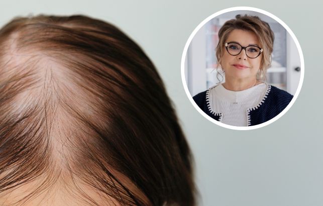 Szczerze opowiedziały o problemach z łysieniem. "Miałam koszmary, że spada mi peruka"